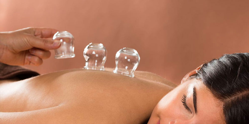 cupping treatment services in hamilton